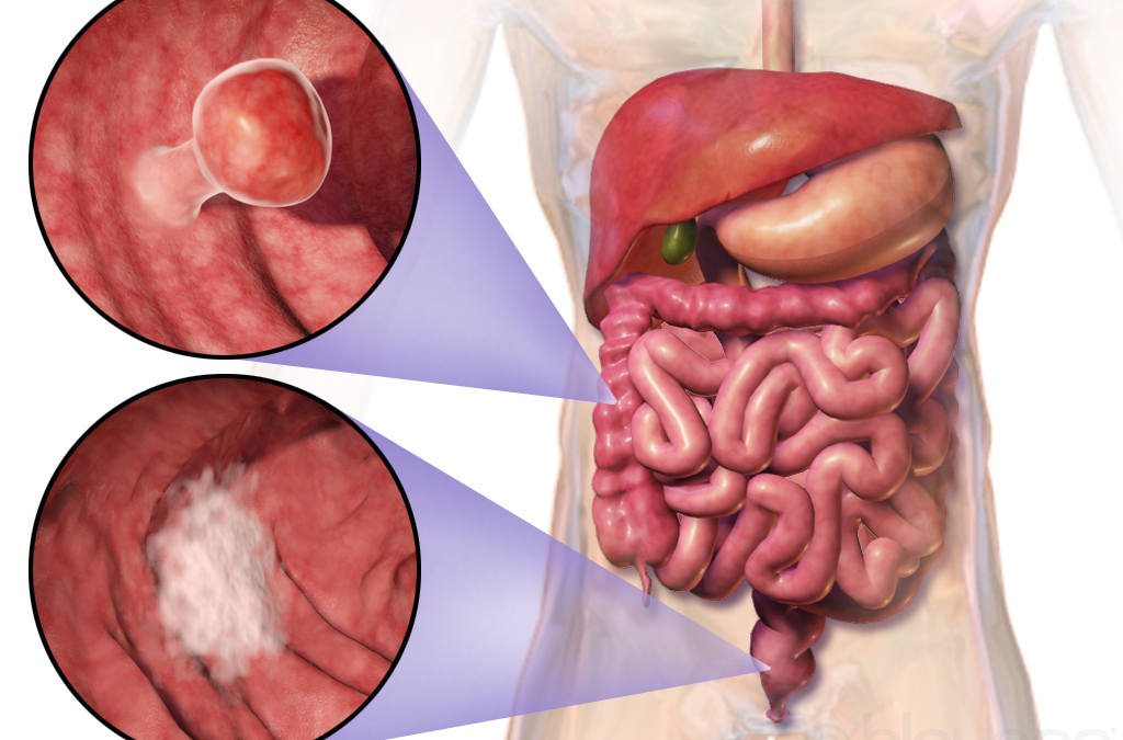 Understanding Colorectal Cancer: Symptoms, Risks & Treatment
