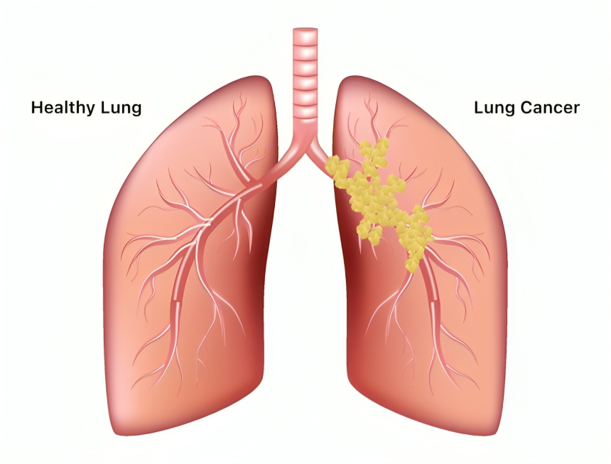 Everything You Need to Know About Lung Cancer