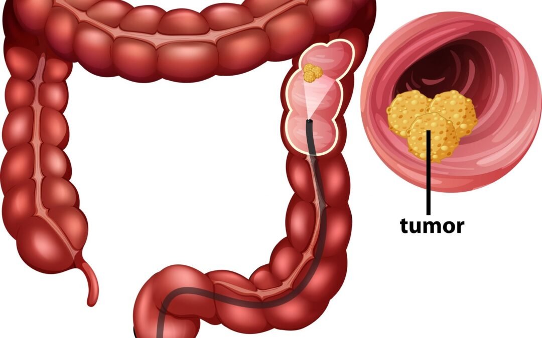 Life After Diagnosis Building Resilience in Colorectal Cancer Survivorship