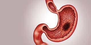 Unmasking GI Cancer: Signs, Risks & Hope