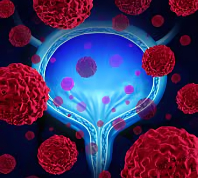 Empowering Lives Support and Strategies for Urological Cancer Patients