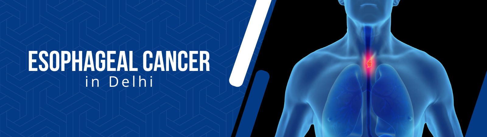 Esophageal-Cancer